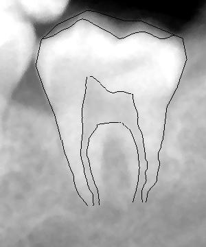 X-ray tooth